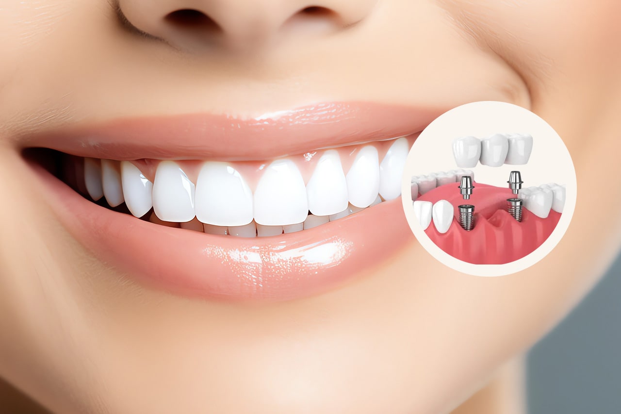 ΠΡΟΣΘΕΤΙΚΗ